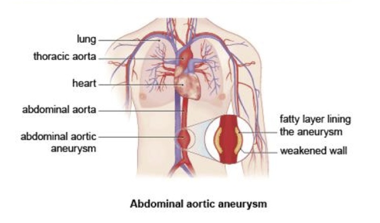 Abdominal aortic aneurysm - Medicare